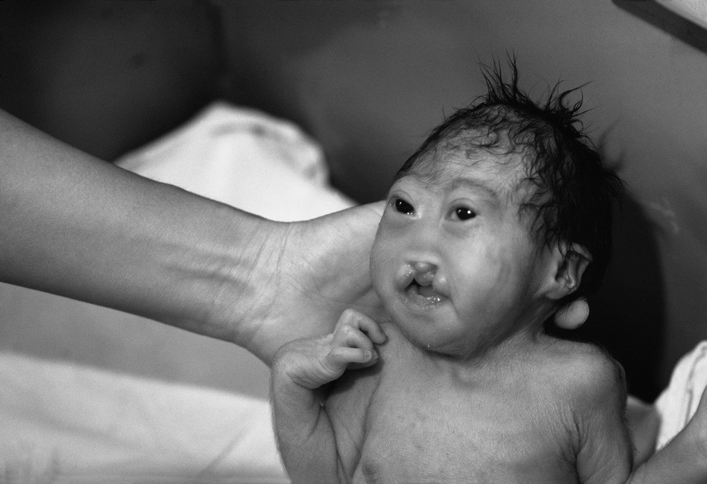 vietnam war agent orange birth defects